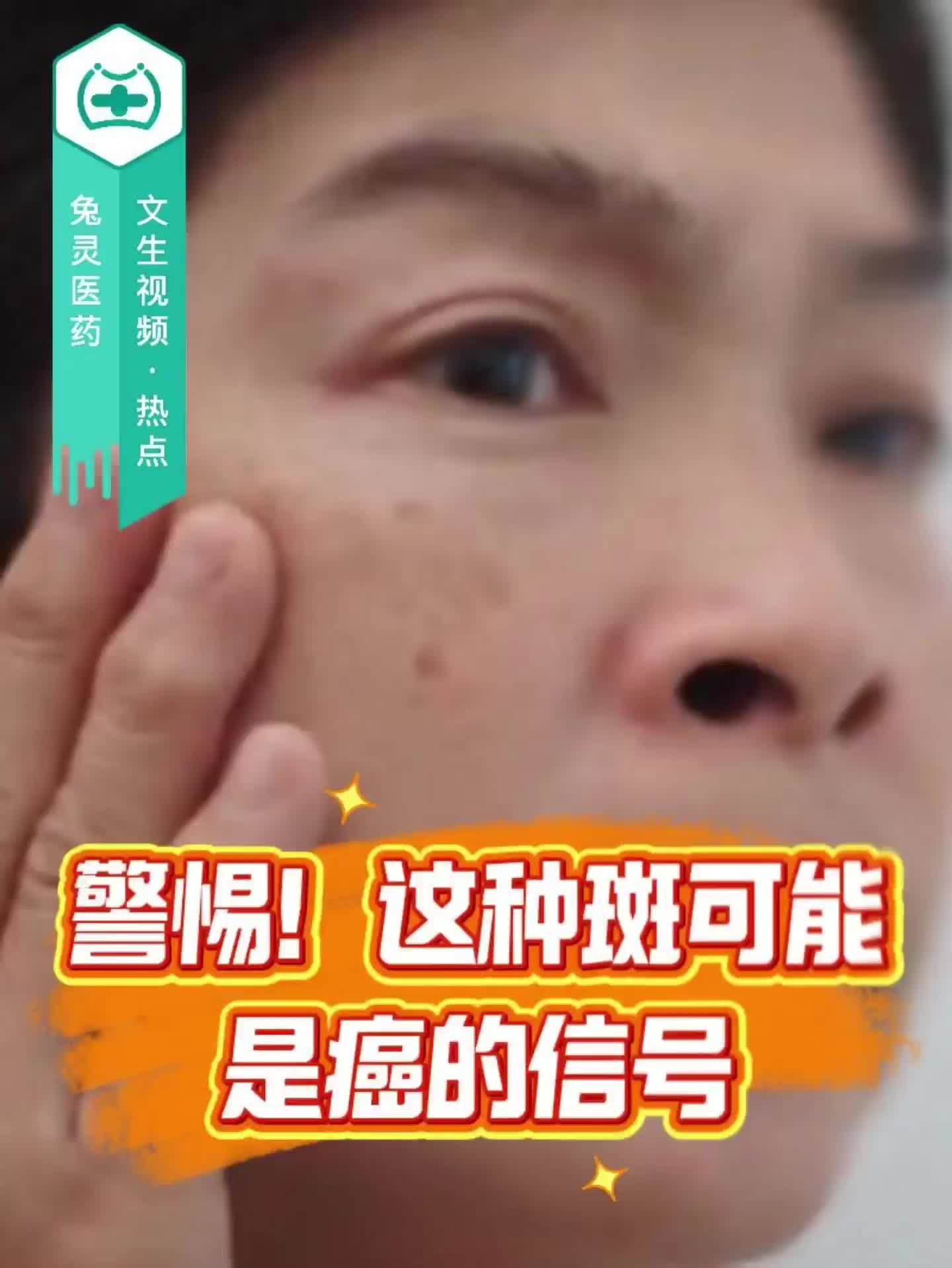 警惕！这种斑可能是癌的信号