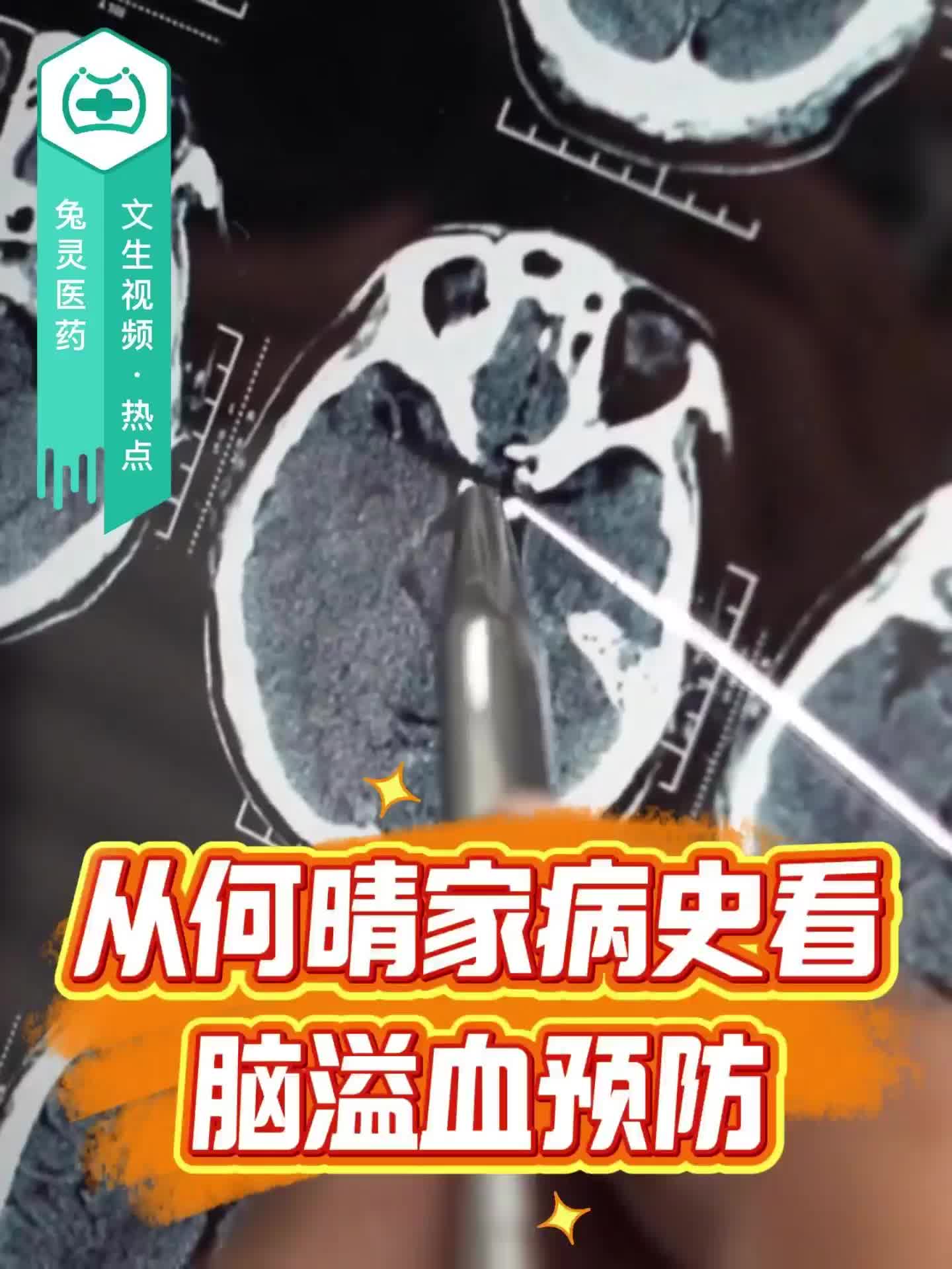 从何晴家病史看脑溢血预防