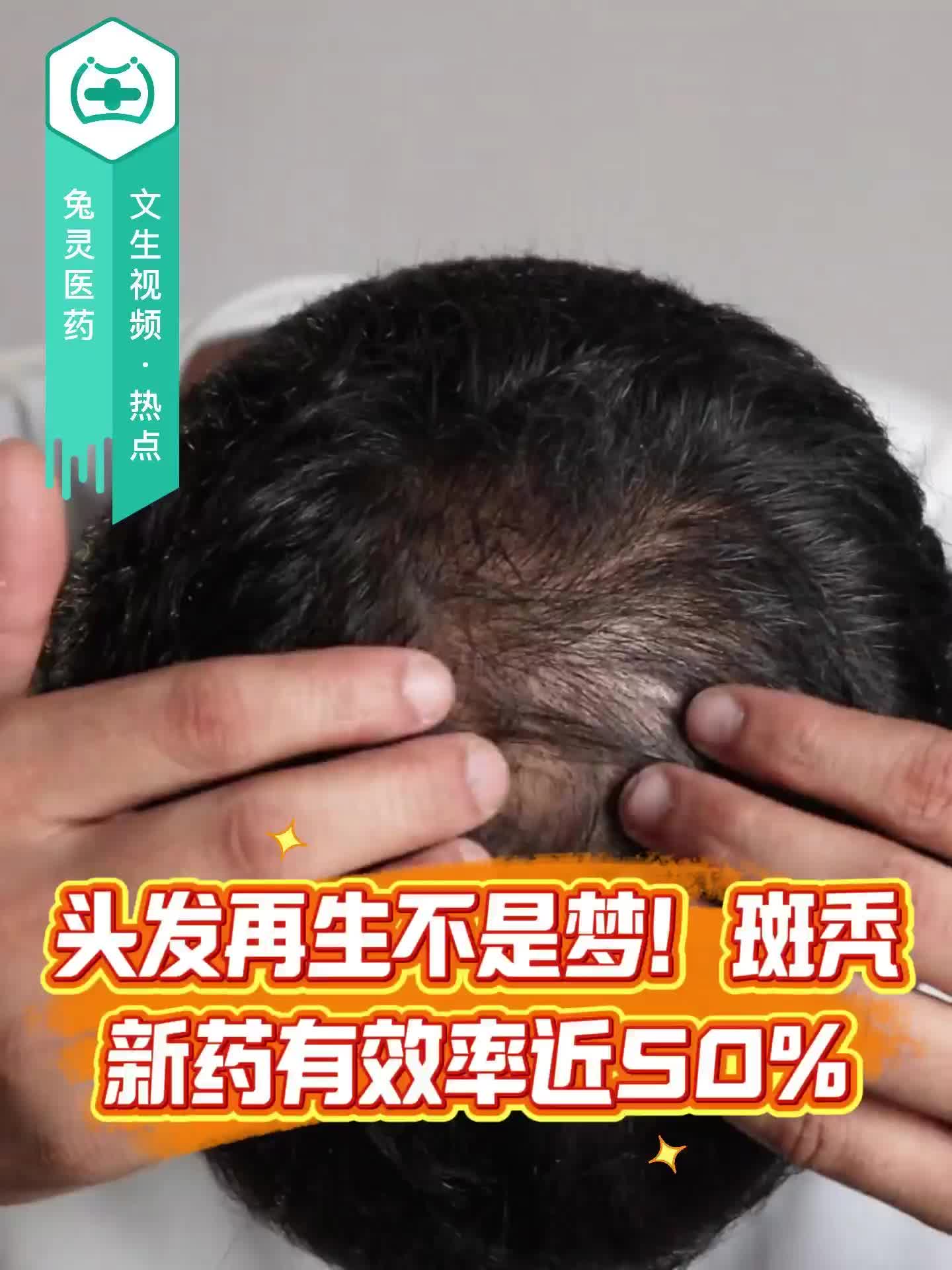 头发再生不是梦！斑秃新药有效率近50%